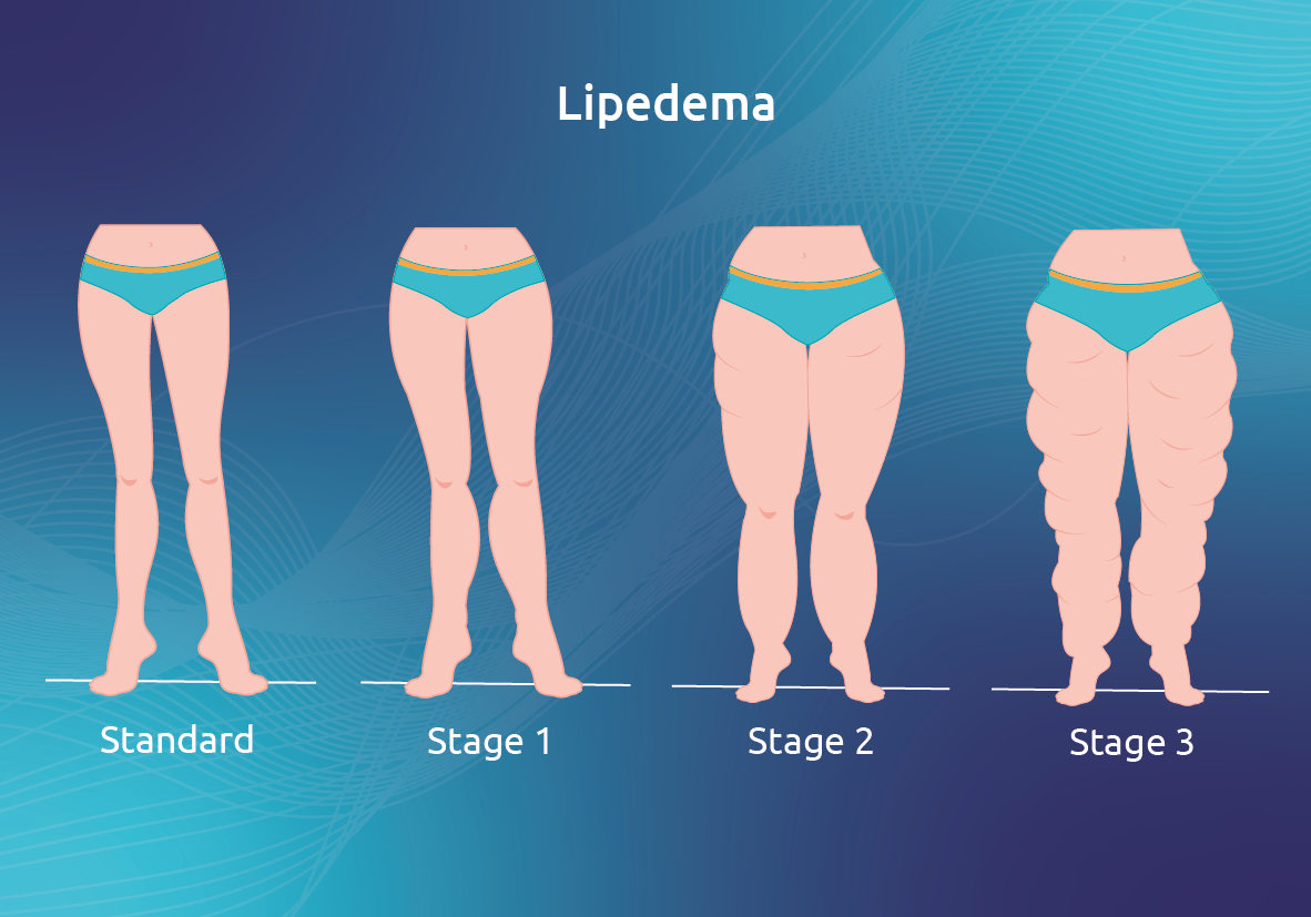 1 in 10 women have this condition - two lipedema patients share